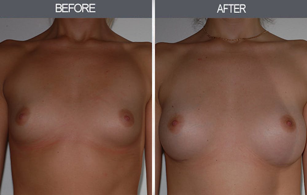 Breast Augmentation Gallery Before & After Gallery - Patient 22935177 - Image 1