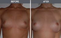Breast Augmentation Before & After Gallery - Patient 22935177 - Image 1