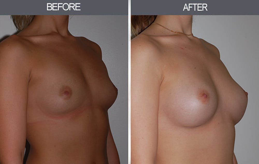 Breast Augmentation Gallery Before & After Gallery - Patient 22935177 - Image 2