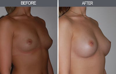 Breast Augmentation Gallery Before & After Gallery - Patient 22935177 - Image 2