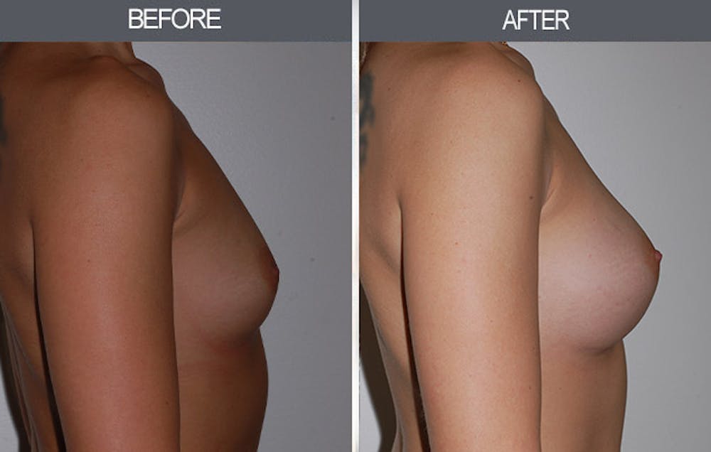 Breast Augmentation Gallery Before & After Gallery - Patient 22935177 - Image 3