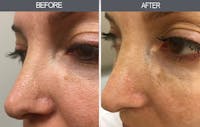 Dermabrasion Gallery Before & After Gallery - Patient 22935470 - Image 1