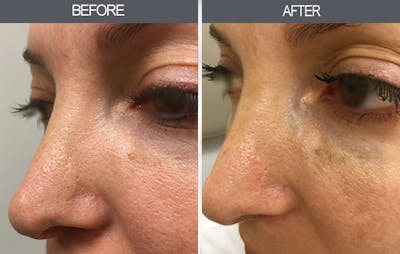 Dermabrasion Gallery Before & After Gallery - Patient 22935470 - Image 1