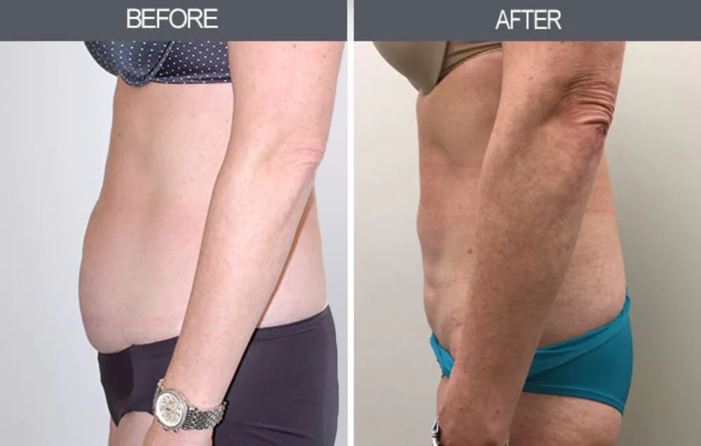 Liposuction Gallery Before & After Gallery - Patient 4448024 - Image 2