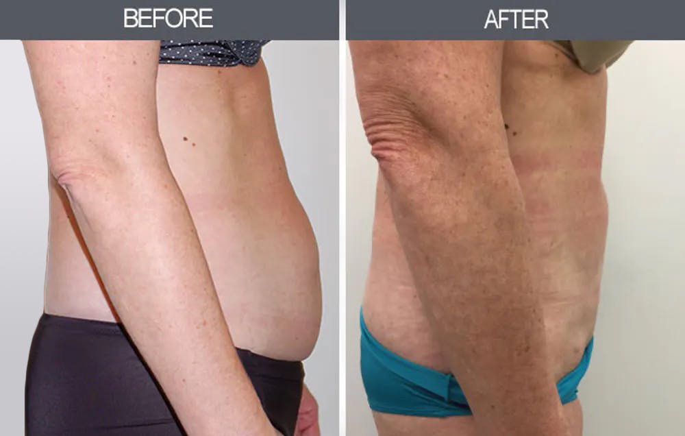 Liposuction Gallery Before & After Gallery - Patient 4448024 - Image 1
