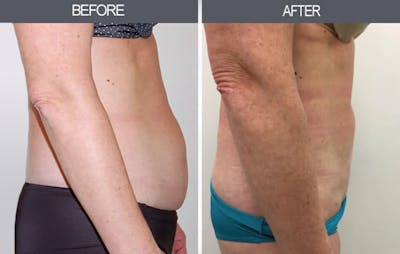 Liposuction Before & After Gallery - Patient 4448024 - Image 1