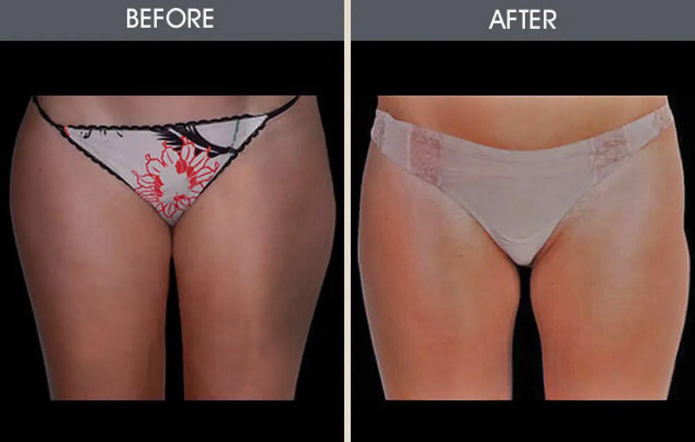 Liposuction Before & After Gallery - Patient 4448025 - Image 1