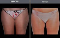 Liposuction Before & After Gallery - Patient 4448025 - Image 1