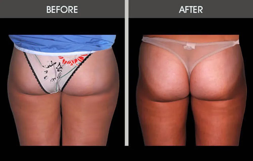 Liposuction Before & After Gallery - Patient 4448025 - Image 2