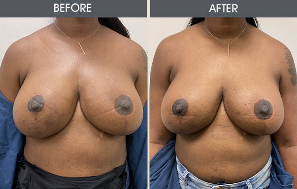 Breast Implant Removal Gallery Before & After Gallery - Patient 26832073 - Image 1