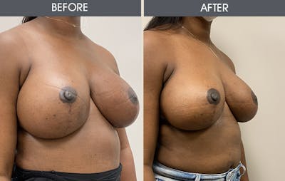 Breast Implant Removal Gallery - Patient 26832073 - Image 2