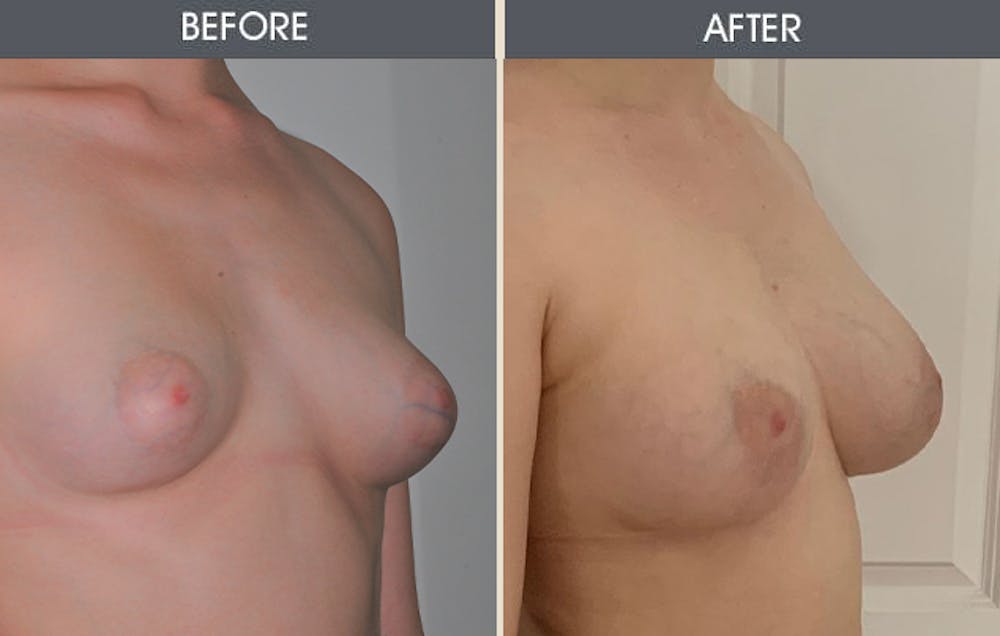 Tuberous Breast Correction Gallery Before & After Gallery - Patient 283214 - Image 1