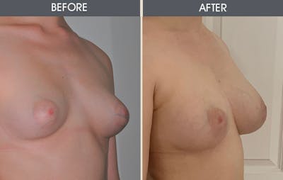 Breast Augmentation Gallery Before & After Gallery - Patient 26833681 - Image 1