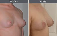 Tuberous Breast Correction Gallery Before & After Gallery - Patient 283214 - Image 1