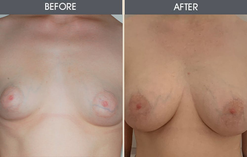 Tuberous Breast Correction Gallery Before & After Gallery - Patient 283214 - Image 2