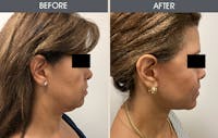 Submental Liposuction Before & After Gallery - Patient 45900401 - Image 1