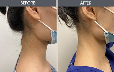 Lipoma Removal Gallery Before & After Gallery - Patient 45900892 - Image 1
