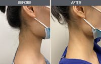 Lipoma Removal Before & After Gallery - Patient 45900892 - Image 1
