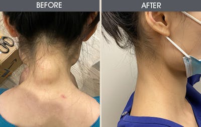 Lipoma Removal Before & After Gallery - Patient 45900892 - Image 2