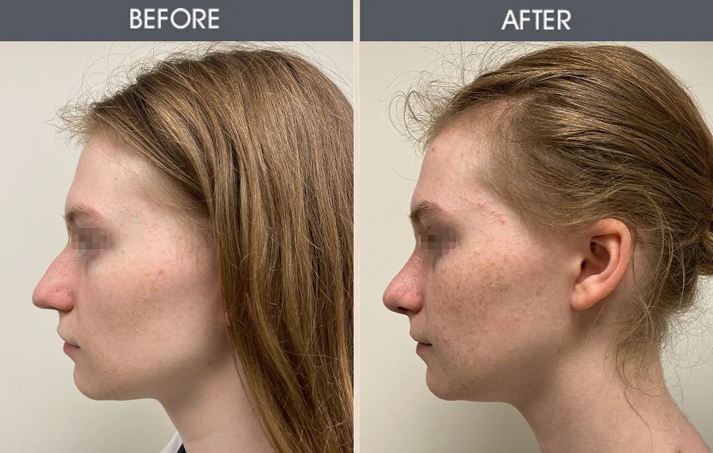 Rhinoplasty Gallery Before & After Gallery - Patient 56995043 - Image 1