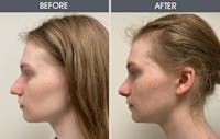 Rhinoplasty Before & After Gallery - Patient 56995043 - Image 1
