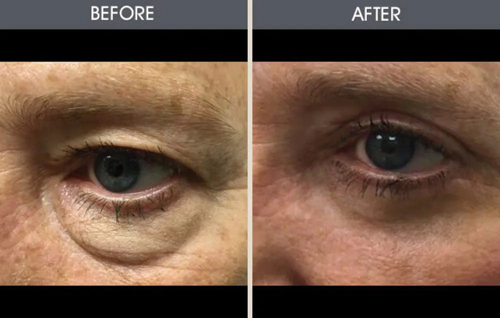 Eyelid Surgery (Blepharoplasty) Gallery Before & After Gallery - Patient 2206481 - Image 1