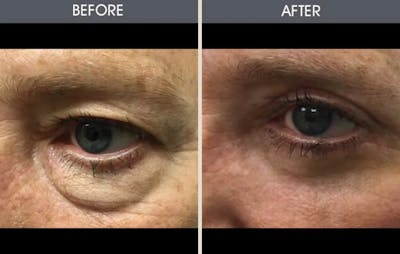 Eyelid Surgery (Blepharoplasty) Gallery Before & After Gallery - Patient 2206481 - Image 1