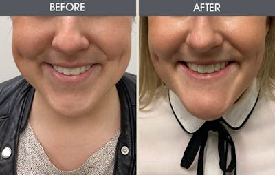 Buccal Fat Removal Before & After Gallery - Patient 93490799 - Image 2