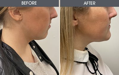 Buccal Fat Removal Gallery Before & After Gallery - Patient 93490799 - Image 1