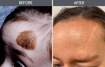 Mole Removal Before & After Gallery - Patient 105313191 - Image 1