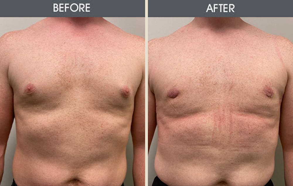 Male Breast Reduction (Gynecomastia) Gallery Before & After Gallery - Patient 105313192 - Image 1