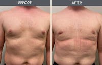 Male Breast Reduction (Gynecomastia) Gallery Before & After Gallery - Patient 105313192 - Image 1