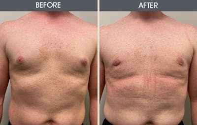 Male Breast Reduction Gallery - Patient 105313192 - Image 1