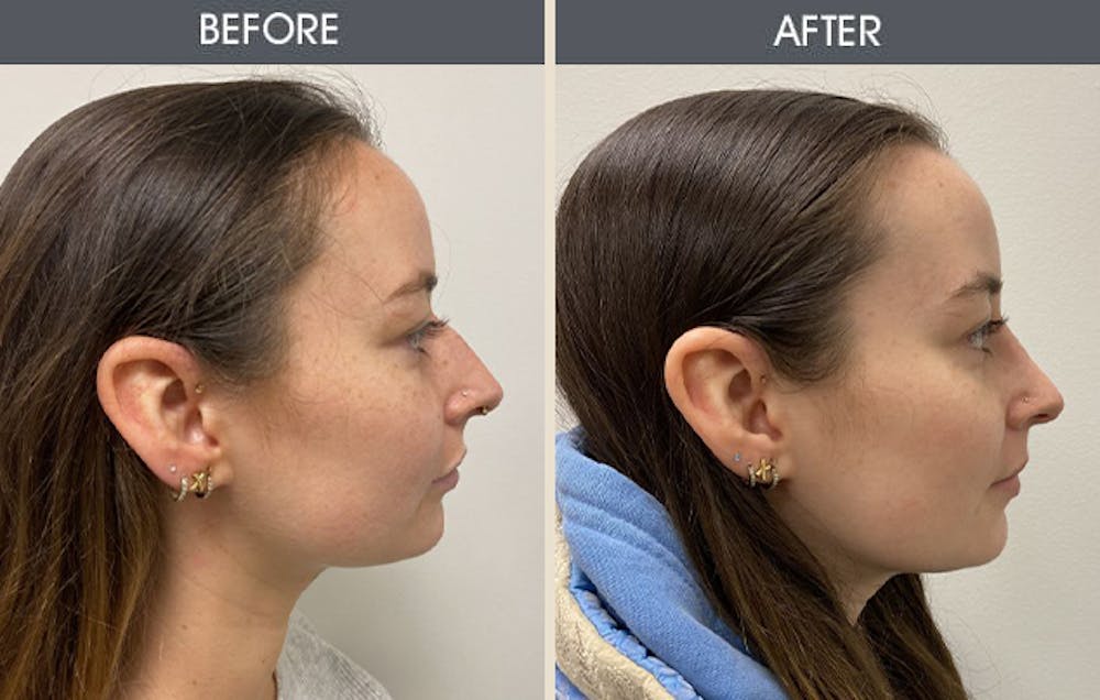 Rhinoplasty Before & After Gallery - Patient 105313198 - Image 1