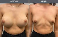 Breast Implant Removal Gallery Before & After Gallery - Patient 149260084 - Image 1