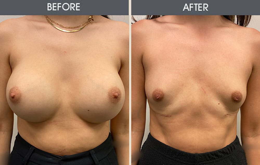 Breast Implant Removal Gallery Before & After Gallery - Patient 149260084 - Image 1