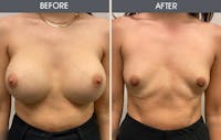 Breast Revision Gallery - Patient 122503472 - Image 1