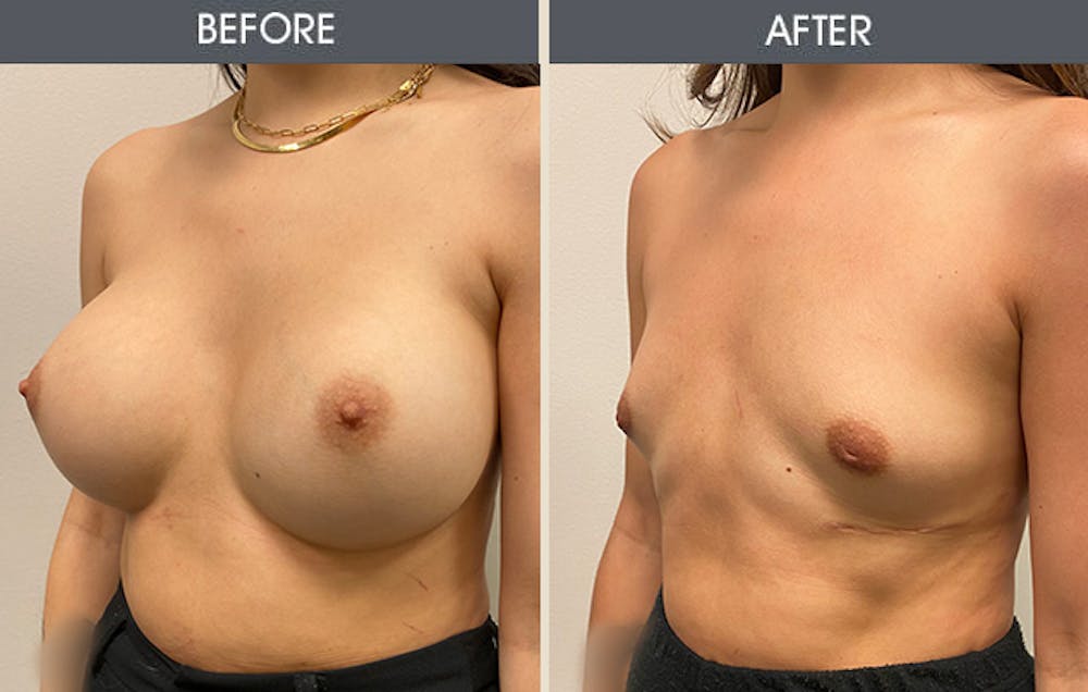 Breast Revision Before & After Gallery - Patient 122503472 - Image 2