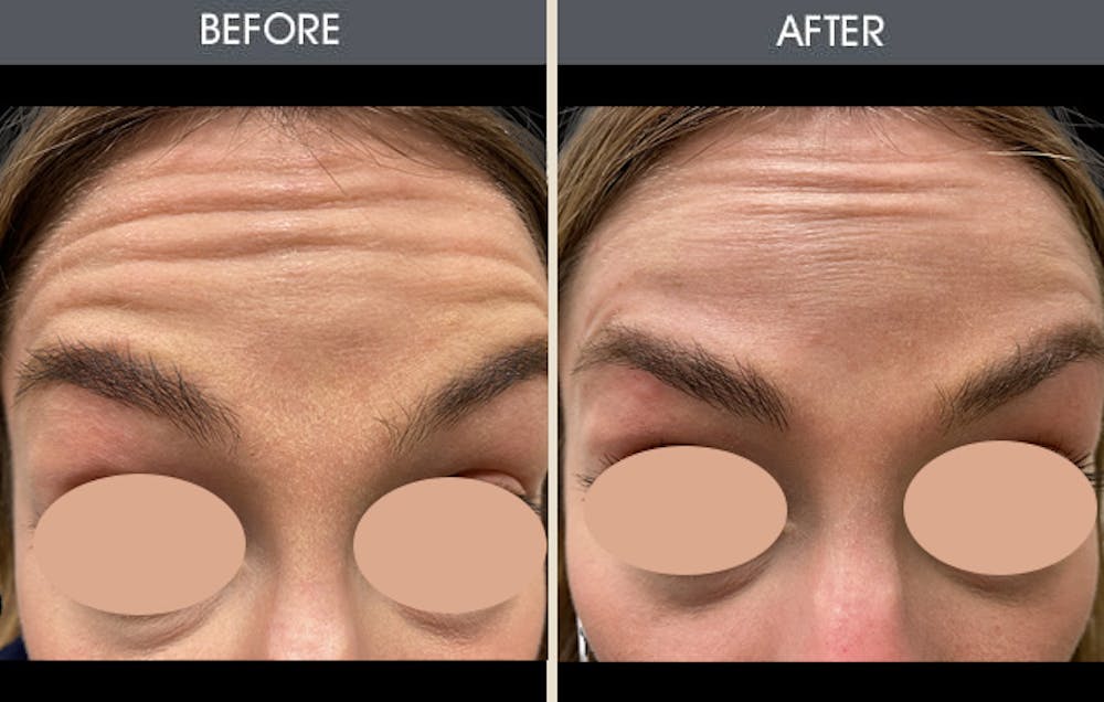 BOTOX Gallery Before & After Gallery - Patient 149147464 - Image 1
