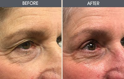 Eyelid Surgery (Blepharoplasty) Gallery Before & After Gallery - Patient 122503816 - Image 1