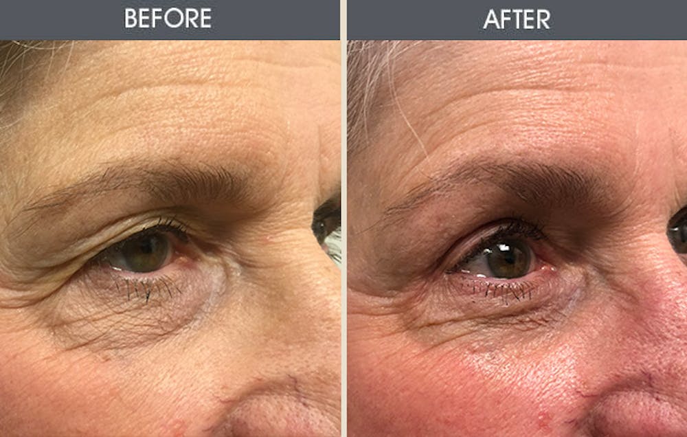 Eyelid Surgery Before & After Gallery - Patient 122503816 - Image 1
