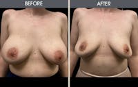 Breast Implant Removal Before & After Gallery - Patient 122503818 - Image 1