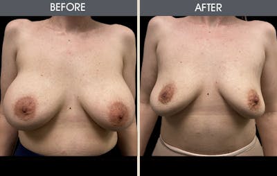Breast Implant Removal Before & After Gallery - Patient 122503818 - Image 1