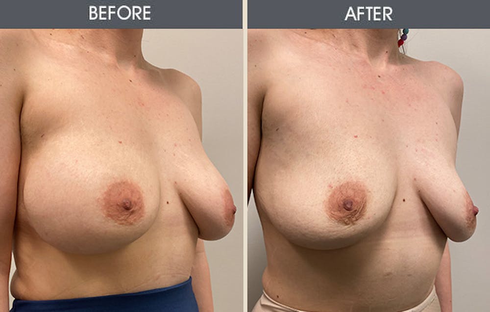 Breast Implant Removal Gallery Before & After Gallery - Patient 122503818 - Image 2