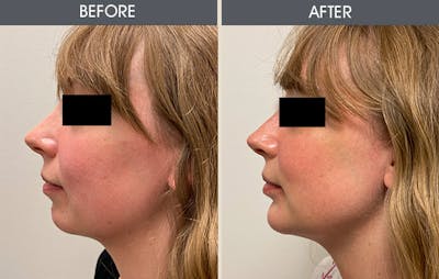 Submental Liposuction Gallery Before & After Gallery - Patient 123045894 - Image 1