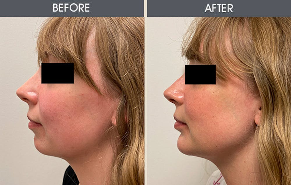 Submental Liposuction Before & After Gallery - Patient 123045894 - Image 1