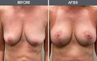Breast Lift Before & After Gallery - Patient 174758 - Image 1