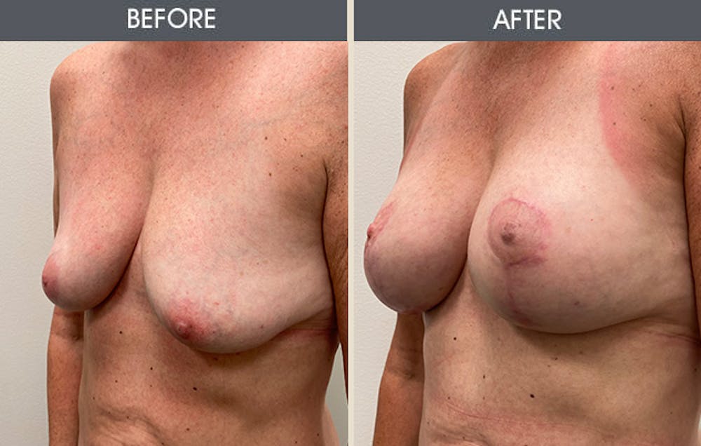 Breast Lift Gallery Before & After Gallery - Patient 174758 - Image 2