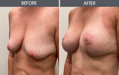 Breast Augmentation Before & After Gallery - Patient 123045900 - Image 2