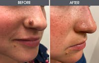 Mole Removal Gallery Before & After Gallery - Patient 4454440 - Image 1